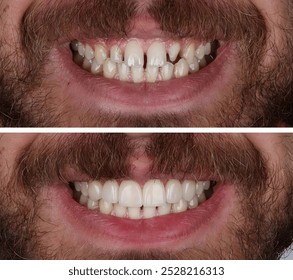 Smile restoration