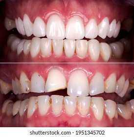 Cosmetic smile treatment