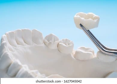Illustration of a dental crown