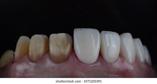 Illustration of ceramic veneer placement